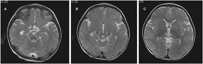 Case Report: m.13513 G>A Mutation in a Chinese Patient With Both Leigh Syndrome and Wolff-Parkinson-White Syndrome